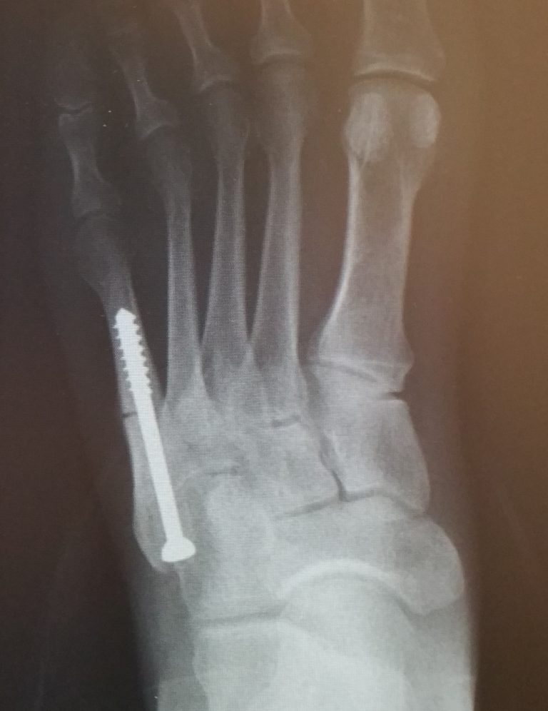 Metatarsal Fractures Doctor Steinlauf